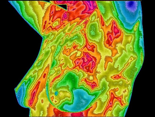 Breast thermogram no. 1