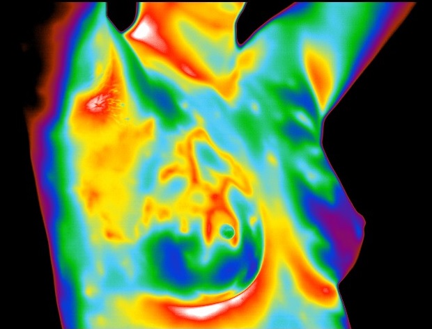 Breast thermogram no. 2