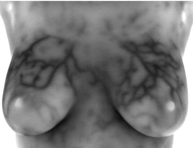 Breast thermogram no. 5